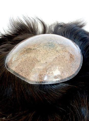 silicon injected hair replacement system