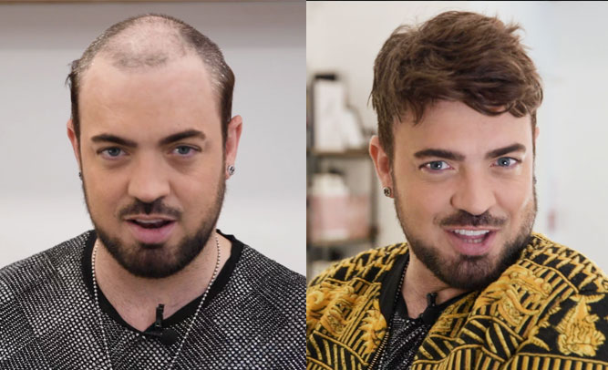 Aaron Lordhair sistema per capelli prima e dopo