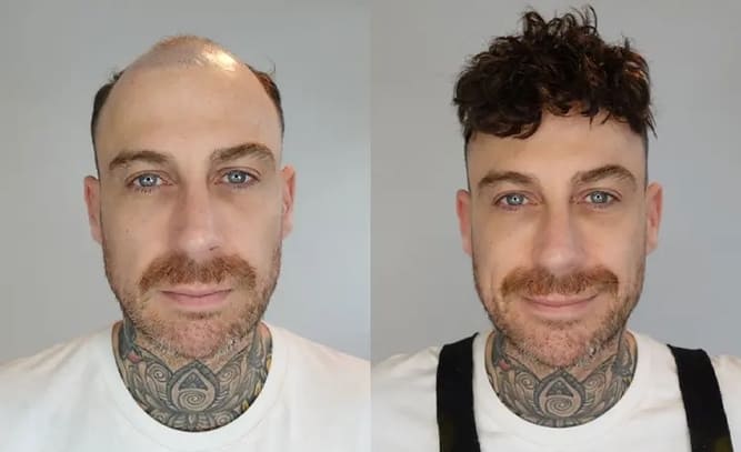 Brad Lordhair sistema per capelli prima e dopo