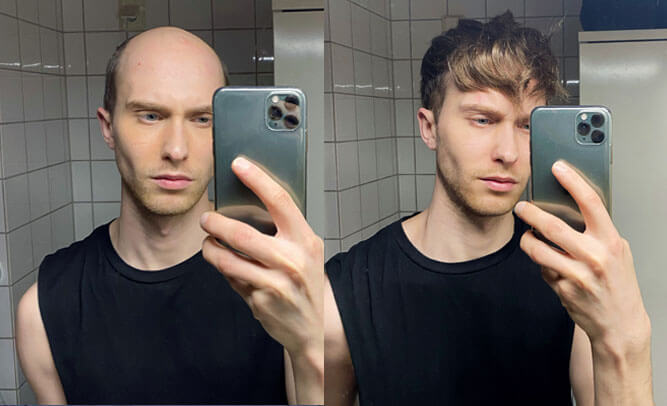 Juha Lordhair sistema capelli prima e dopo