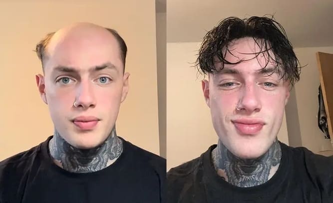 Nick Lordhair sistema per capelli prima e dopo