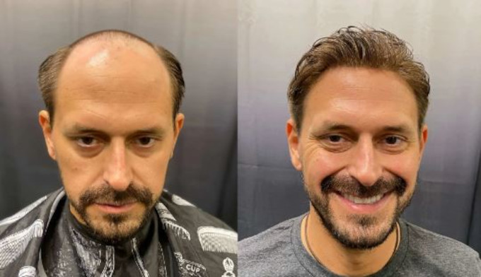 protesi_capillare_clienti_prima_dopo_Lordhair