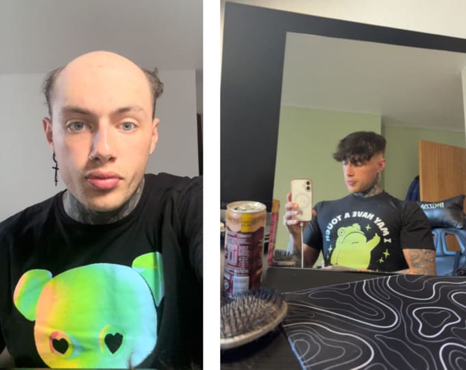 ragazzo_protesi_capelli_prima_dopo