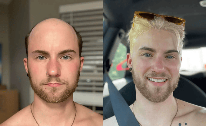 uomo-calvo-con-e-senza-parrucchino