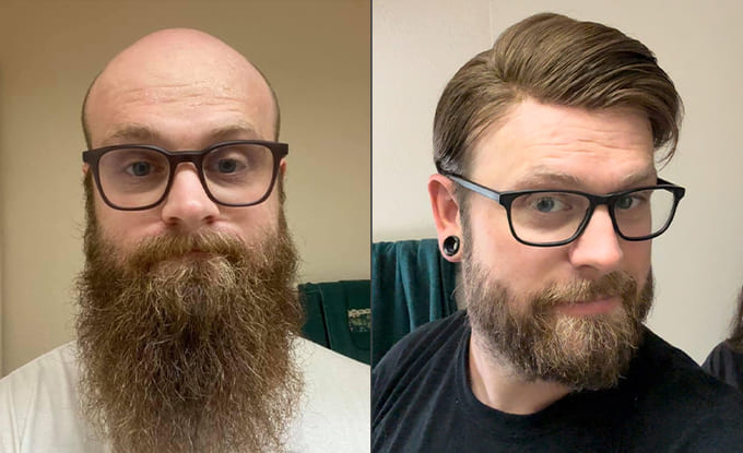 Brandon senza e con la protesi capelli di Lordhair