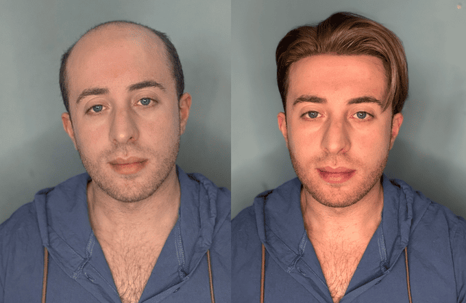 Foto del prima e dopo di un uomo italiano che indossa una protesi capillare