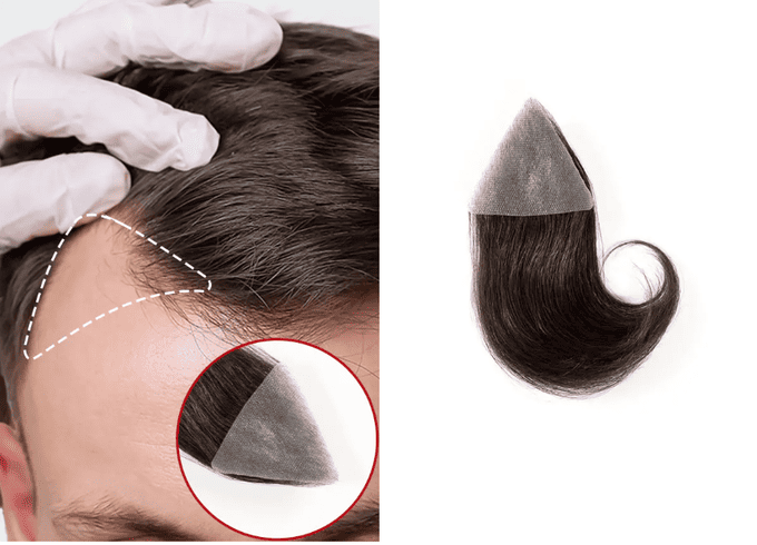 Patch cutanea triangolare per le tempie applicata per coprire la stempiatura maschile