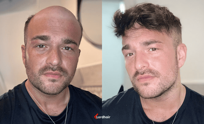 Un uomo prima e dopo aver indossato una protesi capelli