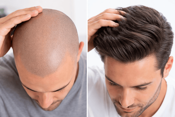 confronto tra tricopigmentazione effetto rasato e protesi capelli con risultato naturale