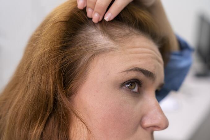 Infoltimento capelli donna: soluzioni per capelli diradati