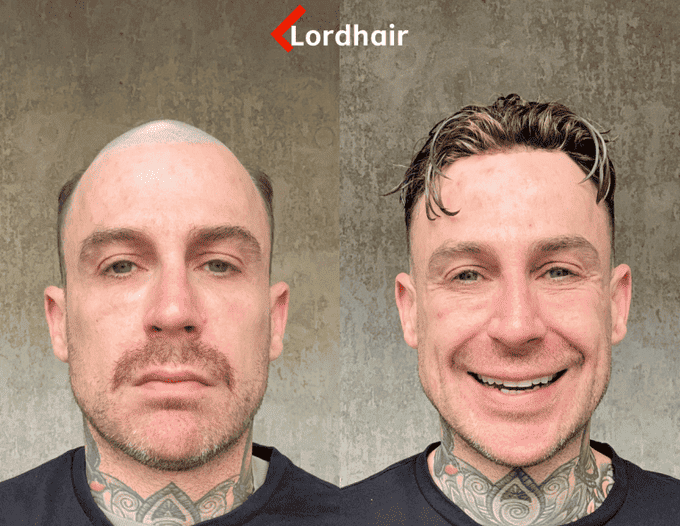Uomo prima e dopo la protesi capillare Lordhair: alternativa non chirurgica al trapianto di capelli