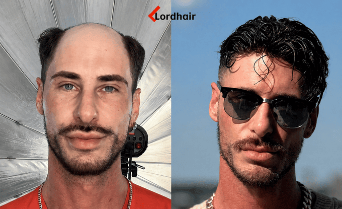 Risultato reale prima e dopo la patch cutanea: utente Lordhair con alopecia frontale a sinistra, capelli naturali con patch cutanea a destra
