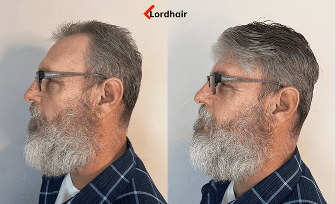 prima e dopo protesi capelli uomo capelli grigi bassa densità Lordhair