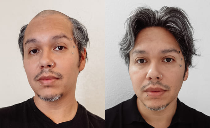Isidro prima e dopo la protesi Superskin-V con il 40% di grigio