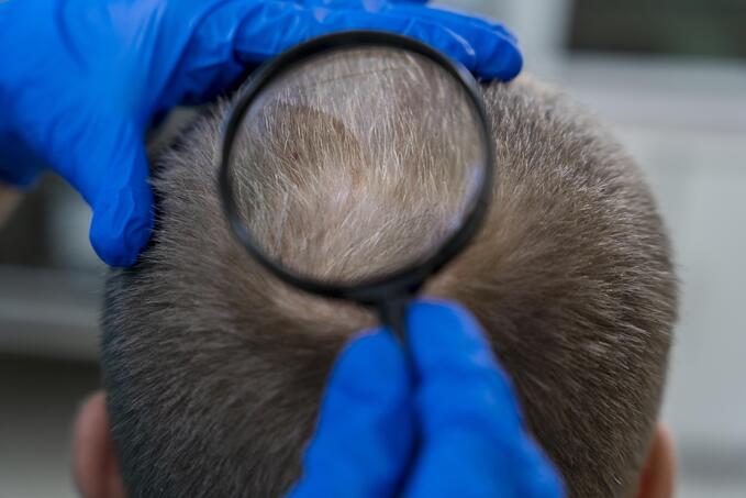 Medico che esamina un'area di calvizie prima di valutare il trapianto di capelli