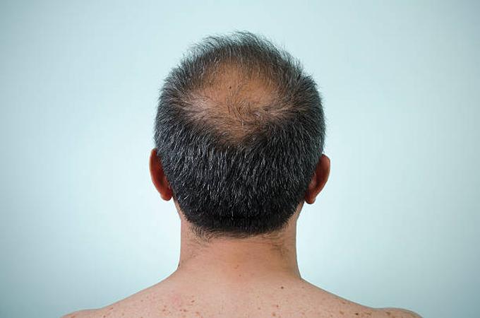Patch Cutanea per Capelli