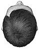hair replacement left break