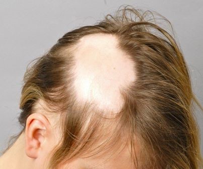 Alopecia areata monolocularis