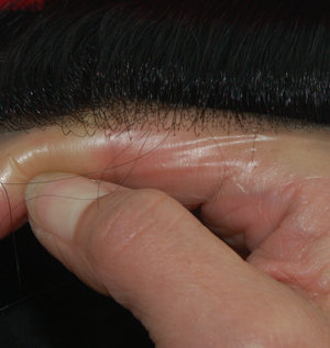 Protesi capelli in skin ultra sottile