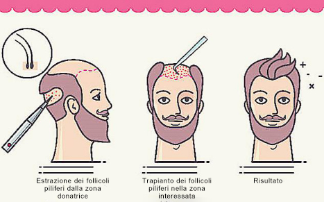 Come funziona un trapianto di capelli