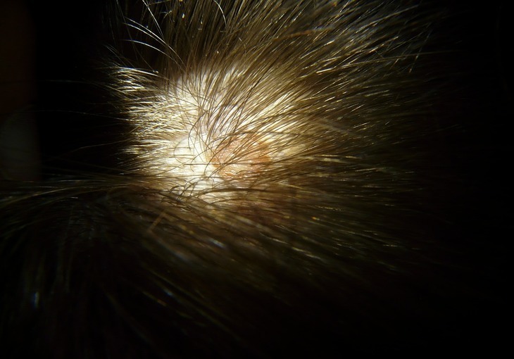 Tinea Capitis