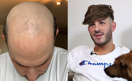 Protesi capelli veri