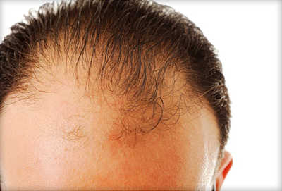 Perdita dei Capelli